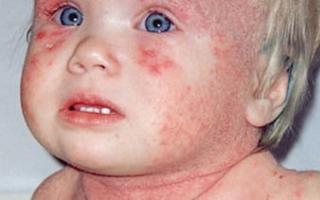 Советы мамам: как распознать и вылечить дерматит у ребенка Лечение атопического дерматита народными средствами