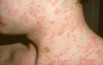 Что такое аллергия и как она возникает: полезная информация для широкого круга читателей Может ли развиться аллергия