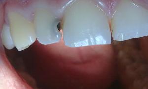 Таблетки от зубной боли: какое обезболивающее лучше