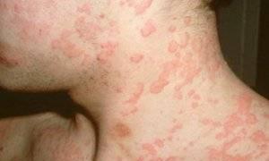 Что такое аллергия и как она возникает: полезная информация для широкого круга читателей Может ли развиться аллергия