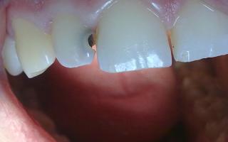Таблетки от зубной боли: какое обезболивающее лучше