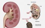 Осложнения на почки и ангина Осложнение на почки симптомы